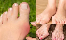 Başparmak Kireçlenmesi Tedavisi Nasıl Yapılır?