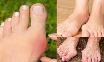 Başparmak Kireçlenmesi Tedavisi Nasıl Yapılır?